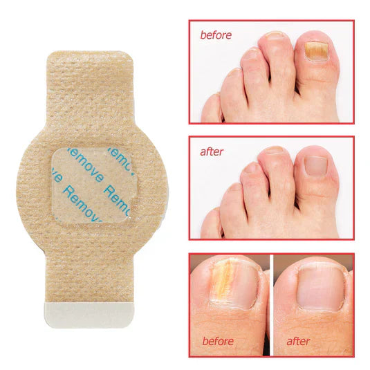Patch Mediche Antifungine